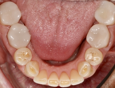 Smile after decay has been treated biomimetically