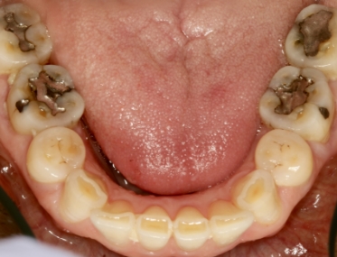 Smile with multiple decayed teeth and silver fillings