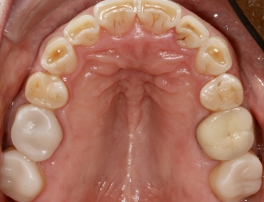 Smile after decay has been treated biomimetically