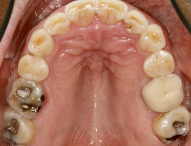 Smile with multiple decayed teeth and silver fillings