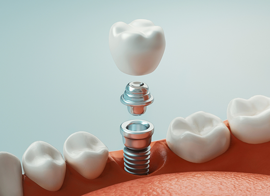 Illustration of abutment and crown being attached to dental implant in Colorado Springs