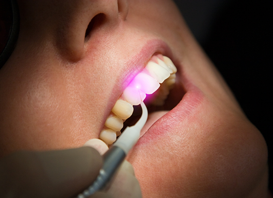 Close up of soft tissue laser being used to treat smile