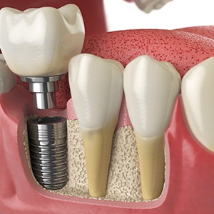 Adult in Colorado Springs smiling at dental implant consultation
Illustration of a dental implant