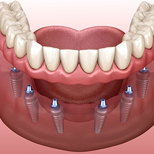 Illustration of implant dentures