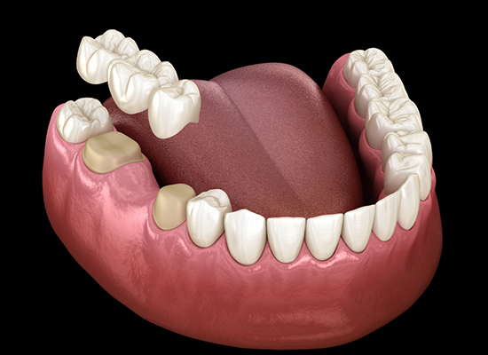 Illustration of lower arch of teeth and dental bridge