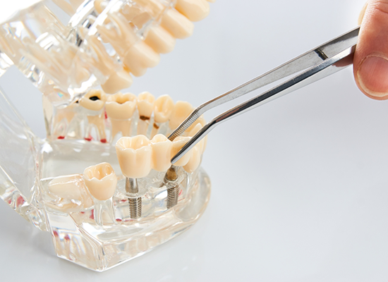 Plastic model with teeth and dental implants