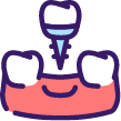 Icon of dental implant being placed