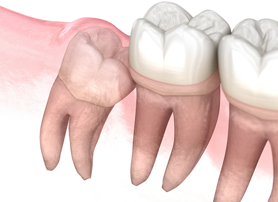Illustration of tooth trapped under gums