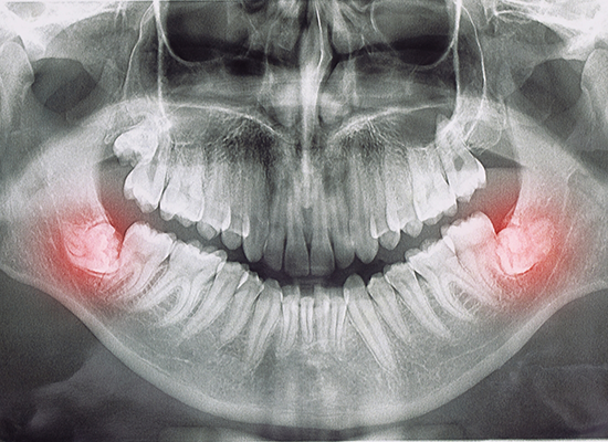X ray showing impacted wisdom teeth